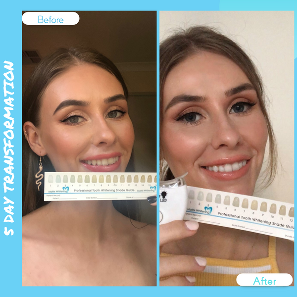 The Ultimate Kit Matrix Whitening